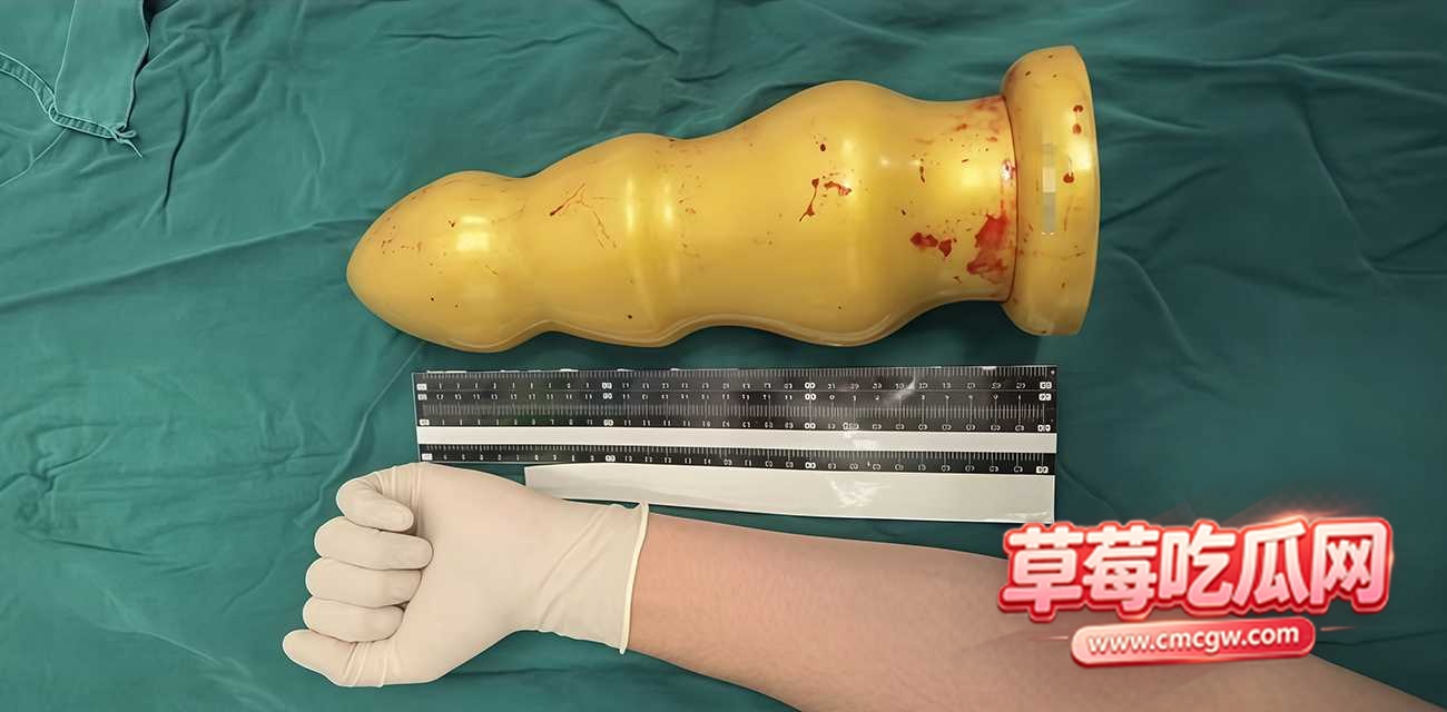 患者肚子里硬塞40厘米巨物毒龙 患者肚子里硬塞40厘米巨物毒龙